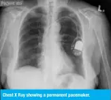 ??  ?? Chest X Ray showing a permanent pacemaker.