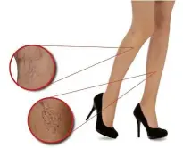  ??  ?? Varicose veins happen when the valves within the vein weaken and do not ensure blood flow in one direction.