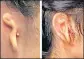  ?? AFP ?? The patient's ear, before and after the surgery.