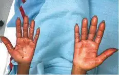  ?? Courtesy: Rashid Hospital ?? The woman’s hand while undergoing treatment. A Rashid Hospital doctor has cautioned people to buy only known brands of hair dye and to do a patch test to check for any adverse reaction.