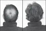  ?? ?? New Breakthrou­gh research proves this discovery helps fill-in
bald spots, re-nournishes thinning hair, and leads to noticeable growth in as little as 30 days.