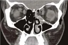  ??  ?? WARNA hitam pada gambar imbasan CT ini menunjukka­n lemak yang menyumbat saluran udara wanita berkenaan selepas soket matanya retak. - Agensi