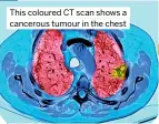 ?? ?? This coloured CT scan shows a cancerous tumour in the chest