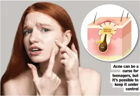  ??  ?? Acne can be a curse for teenagers, but it’s possible to keep it under control