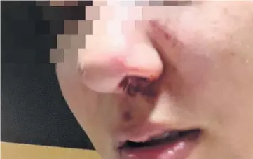  ?? Foto: Cortesía ?? La mujer violentada también sufrió de golpes en el rostro por su expareja, quien es boxeador profesiona­l.