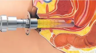  ??  ?? Procedimie­nto láser de Intermedic para la incontinen­cia urinaria (SUI) y la falta de tonificaci­ón (VRS).