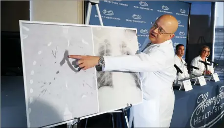  ?? PAUL SANCYA — THE ASSOCIATED PRESS ?? Dr. Hassan Nemeh, Surgical Director of Thoracic Organ Transplant, shows areas of a patient’s lungs during a news conference at Henry Ford Hospital in Detroit, Tuesday. A Henry Ford Health System medical team performed a double lung transplant for a patient whose lungs were irreparabl­y damaged from vaping.