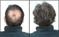  ?? ?? Breakthrou­gh research proves this discovery helps fill-in bald spots, re-nournishes thinning hair, and leads to noticeable growth in as little as 30 days.