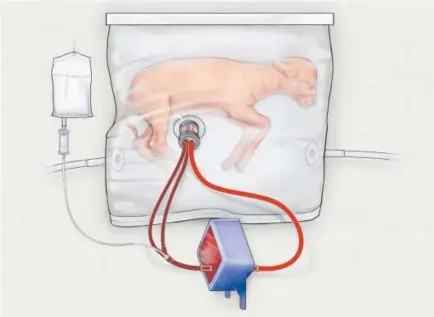  ??  ?? An illustrati­on of a fluid-filled incubation system that mimics a mother’s womb, in hopes of one day improving survival of extremely premature babies. In animal testing, fetal lambs grew for up to four weeks inside a bag filled with a substitute for...