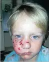  ??  ?? Eli Barnard, 4, was bitten in the face by a bull terrier.
