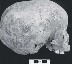  ??  ?? 0 Evidence of head binding on Orkney? A child’s skull found in the Tomb of The Eagles at Isbister in Orkney, right, which shows a hollow around half way along