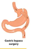  ??  ?? Gastric bypass
surgery