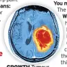  ??  ?? GROWTH Tumour