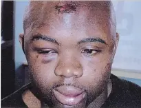  ?? TORONTO STAR FILE PHOTO ?? Photos taken of Orlando Bowen in 2004 after his arrest show him with gashes, as well as swollen eyes, cheeks and lips.