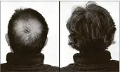  ??  ?? Breakthrou­gh research proves this discovery helps fill-in bald spots, re-nournishes thinning hai r,andle ads to noticeable growth in as little as 30 days.