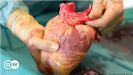  ??  ?? Could artificial hearts one day make up the shortfall in donated human hearts?