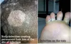  ??  ?? Scalp infection causing permanent hair loss at the site of infection
Infection on the toes