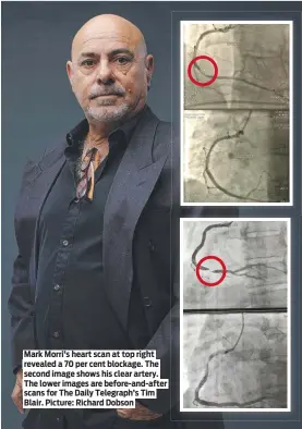  ?? ?? Mark Morri’s heart scan at top right revealed a 70 per cent blockage. The second image shows his clear artery. The lower images are before-and-after scans for The Daily Telegraph’s Tim Blair. Picture: Richard Dobson