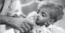  ?? HANI MOHAMMED/AP ?? A father gives water to his malnourish­ed daughter in a hospital in Hodeida, Yemen, in 2018. An internatio­nal aid group says about 85,000 children under age 5 have died of hunger and disease since the outbreak of Yemen’s civil war in 2015.