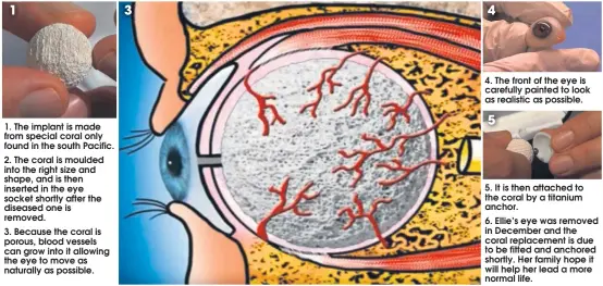  ??  ?? 1
1. The implant is made from special coral only found in the south Pacific. 2. The coral is moulded into the right size and shape, and is then inserted in the eye socket shortly after the diseased one is removed. 3. Because the coral is porous, blood...