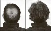  ?? ?? Breakthrou­gh research proves this discovery helps fill-in bald spots, re-nournishes thinning hair, and leads to noticeable growth in as little as 30 days.