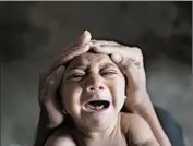  ?? FELIPE DANA/AP ?? A baby with a birth defect thought to be linked to Zika wails in Brazil. The virus has spread through the Americas.