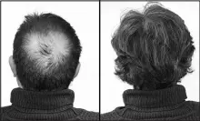  ??  ?? Breakthrou­gh research proves this discovery helps fill-in bald spots, re-nournishes thinning hair, and leads to noticeable growth in as little as 30 days.