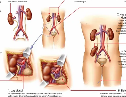  ??  ?? 5. Montering
Arterier og vener fra donornyren sys sammen med arterier og vener hos mottakeren.
1. Donoren
Donor- nyren hentes, sammen med et langt nok stykke av arterier, vener og urinleder slik at den blir enklere å implantere i mottakeren.
4. Lag...