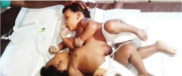  ??  ?? Grace and Mercy before the surgery. Their parents were subjected to insults for having them, the mother says