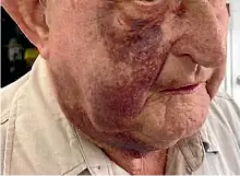  ??  ?? A single punch left the Waikato man bleeding from his nose and mouth for more than two hours.