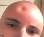  ?? Photo: ?? Cade Hucakabay made a dent in his forehead by poking the swelling caused by his sunburn.