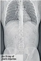  ??  ?? An X-ray of Joe’s injuries