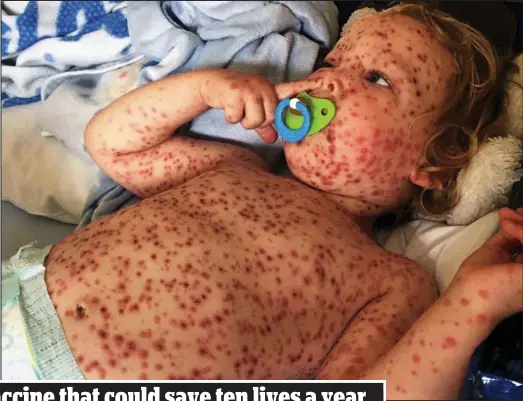  ??  ?? Covered in sores: Toddler Jasper Allen being treated in hospital