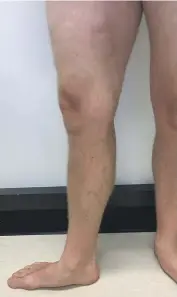  ?? ?? A patient’s legs before and after being treated with Endovenous Ablation at Skin Institute.