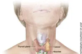  ?? ?? ANATOMY of a thyroid cancer.