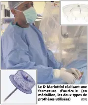  ??  ?? Le Dr Mariottini réalisant une fermeture d’auricule (en médaillon, les deux types de prothèses utilisées) (DR)