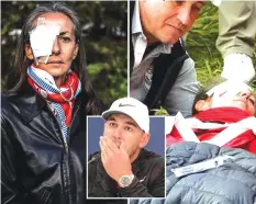  ?? Picture sourced from The Sun. ?? Ryder Cup fan whose eyeball exploded when she was hit by Brooks Koepka's golf ball says she could have been killed and blames organisers.