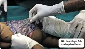  ??  ?? Skin from tilapia fish can help heal burns.