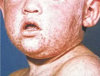  ?? Centers for Disease Control / Tribune News Service ?? The face of a boy after three days with a measles rash. The United States declared measles eliminated in 2000, but “anti-vaxxers” have allowed for its return with 22 outbreaks this year.