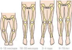  ?? ?? обычно О-образная и Х-образная деформация ног — варианты возрастной нормы, и положение ног выправится само по себе