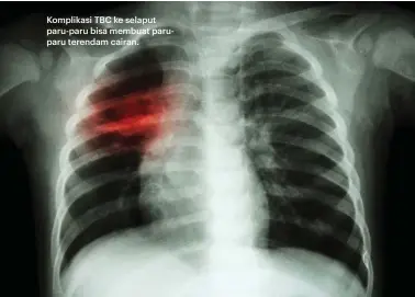  ??  ?? Komplikasi TBC ke selaput paru-paru bisa membuat paruparu terendam cairan.