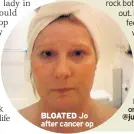  ??  ?? BLOATED Jo after cancer op