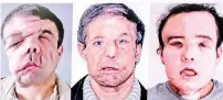  ?? AFP ?? A screen showing different steps of Jerome Hamon’s surgery on April 13, 2018 at the Hopital Europeen Georges-Pompidou in Paris. Hamon is the first man in the world to twice undergo a face transplant after flu tablets incompatib­le with his...