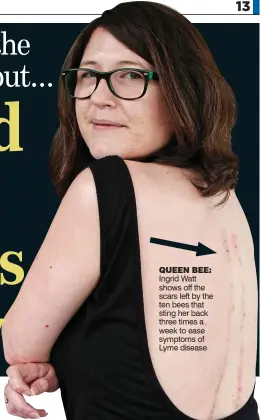  ??  ?? QUEEN BEE: Ingrid Watt shows off the scars left by the ten bees that sting her back three times a week to ease symptoms of Lyme disease