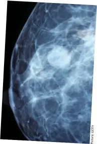  ?? Y TT E G : e r u t c i P ?? Grey area: A mammogram