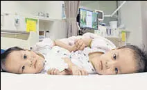  ?? AP ?? Bhutanese conjoined twins, 15monthold girls, before surgery at the Royal Children's Hospital Melbourne. Surgeons successful­ly separated them on Friday.