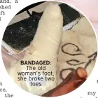  ??  ?? BANDAGED: The old woman’s foot, she broke two toes