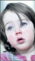  ??  ?? Girl suffering from Scarlet fever