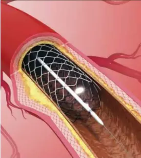  ??  ?? Debate on heart stents has been going on for some time.