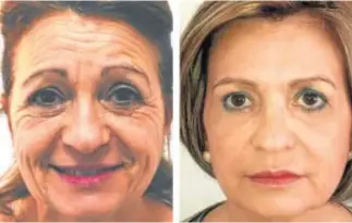  ??  ?? Rejuveneci­mi ento global del rostro con técnica 4x9 (sin cirugía) Dr. Kosmecki (Clínicas Verkomed).